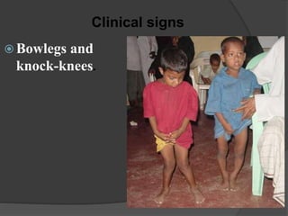  Bowlegs and
knock-knees.
Clinical signs
 