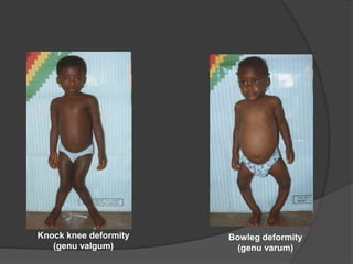 Knock knee deformity
(genu valgum)
Bowleg deformity
(genu varum)
 