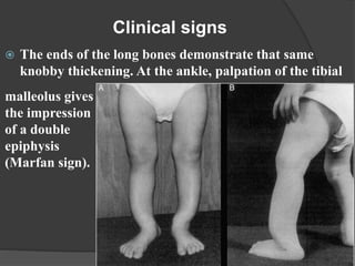  The ends of the long bones demonstrate that same
knobby thickening. At the ankle, palpation of the tibial
Clinical signs
malleolus gives
the impression
of a double
epiphysis
(Marfan sign).
 