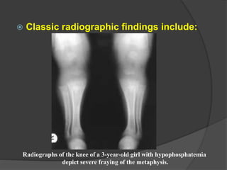  Classic radiographic findings include:
Radiographs of the knee of a 3-year-old girl with hypophosphatemia
depict severe fraying of the metaphysis.
 