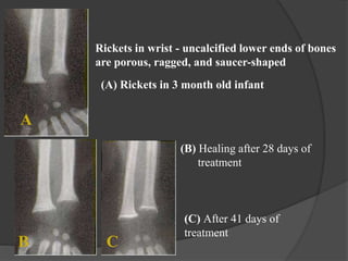 Rickets in wrist - uncalcified lower ends of bones
are porous, ragged, and saucer-shaped
(A) Rickets in 3 month old infant
(B) Healing after 28 days of
treatment
(C) After 41 days of
treatment
A
B C
 