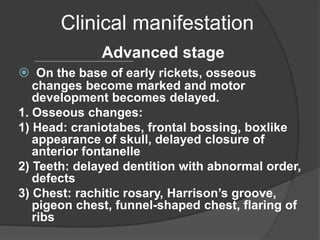 Clinical manifestation
Advanced stage
 On the base of early rickets, osseous
changes become marked and motor
development becomes delayed.
1. Osseous changes:
1) Head: craniotabes, frontal bossing, boxlike
appearance of skull, delayed closure of
anterior fontanelle
2) Teeth: delayed dentition with abnormal order,
defects
3) Chest: rachitic rosary, Harrison’s groove,
pigeon chest, funnel-shaped chest, flaring of
ribs
 