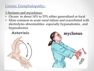 1-Seziures and myoclonus:
• Occurs in about 14% to 33% either generalized or focal
• More common in acute renal failure and exacerbated with
electrolytes abnormalities especially hyponatremia , and
hypocalcemia
myclonus
 