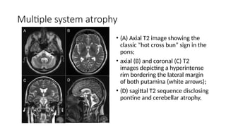 Imaging in Metabolic encephalopathy and dementia | PPTX