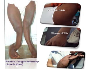 Pot Belly in rickets
Widening of Wrist
Rickets : Valgus deformity
( knock Knee)
 