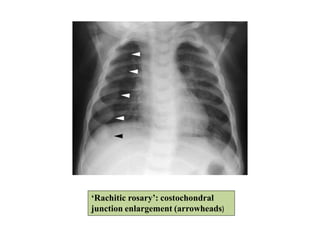‘Rachitic rosary’: costochondral
junction enlargement (arrowheads)
 