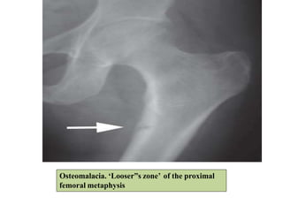 Osteomalacia. ‘Looser”s zone’ of the proximal
femoral metaphysis
 