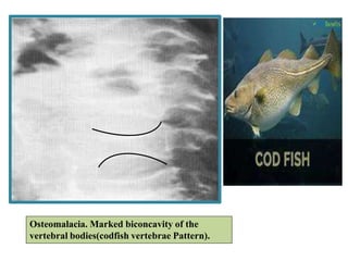 Osteomalacia. Marked biconcavity of the
vertebral bodies(codfish vertebrae Pattern).
 