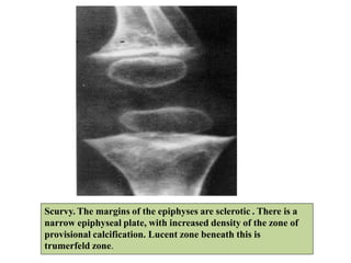Scurvy. The margins of the epiphyses are sclerotic . There is a
narrow epiphyseal plate, with increased density of the zone of
provisional calcification. Lucent zone beneath this is
trumerfeld zone.
 