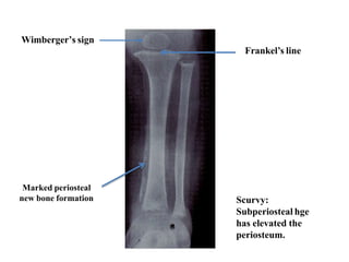 Scurvy:
Subperiosteal hge
has elevated the
periosteum.
Wimberger’s sign
Frankel’s line
Marked periosteal
new bone formation
 