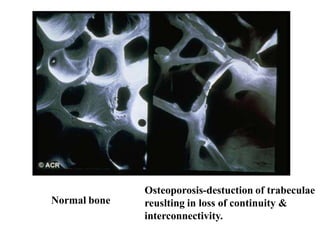 Normal bone
Osteoporosis-destuction of trabeculae
reuslting in loss of continuity &
interconnectivity.
 