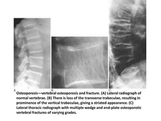 Osteoporosis—vertebral osteoporosis and fracture. (A) Lateral radiograph of
normal vertebrae. (B) There is loss of the transverse trabeculae, resulting in
prominence of the vertical trabeculae, giving a striated appearance. (C)
Lateral thoracic radiograph with multiple wedge and end-plate osteoporotic
vertebral fractures of varying grades.
 