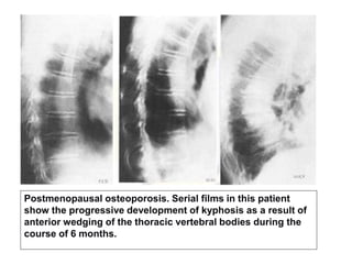 Postmenopausal osteoporosis. Serial films in this patient
show the progressive development of kyphosis as a result of
anterior wedging of the thoracic vertebral bodies during the
course of 6 months.
 