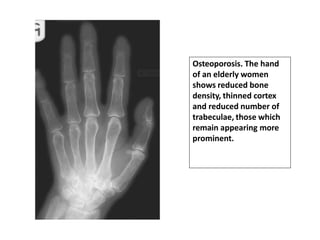 Osteoporosis. The hand
of an elderly women
shows reduced bone
density, thinned cortex
and reduced number of
trabeculae, those which
remain appearing more
prominent.
 