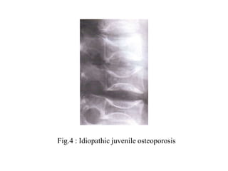 Fig.4 : Idiopathic juvenile osteoporosis
 