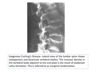 Exogenous Cushing’s Disease- Lateral view of the lumbar spine shows
osteoporosis and biconcave vertebral bodies. The increase density in
the vertebral body adjacent to the end plate is the result of exuberant
callus formation. This is referred to as marginal condensation.
 