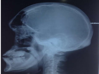 Acromegaly: frontal sinuses markedly enlarged & there is frontal
bossing.
 