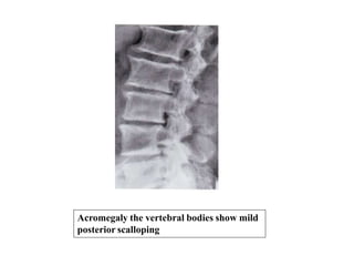 Acromegaly the vertebral bodies show mild
posterior scalloping
 