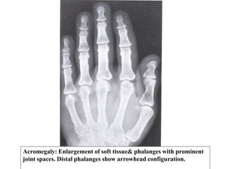 Acromegaly: Enlargement of soft tissue& phalanges with prominent
joint spaces. Distal phalanges show arrowhead configuration.
 