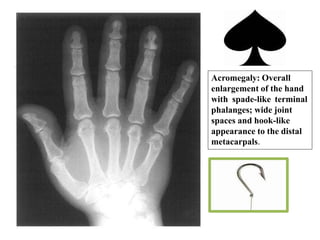 Acromegaly: Overall
enlargement of the hand
with spade-like terminal
phalanges; wide joint
spaces and hook-like
appearance to the distal
metacarpals.
 