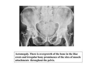 Acromegaly. There is overgrowth of the bone in the iliac
crests and irregular bony prominence of the sites of muscle
attachments throughout the pelvis.
 
