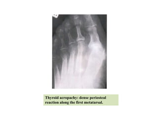 Thyroid acropachy: dense periosteal
reaction along the first metatarsal.
 