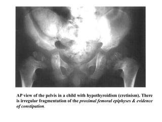 AP view of the pelvis in a child with hypothyroidism (cretinism). There
is irregular fragmentation of the proximal femoral epiphyses & evidence
of constipation.
 