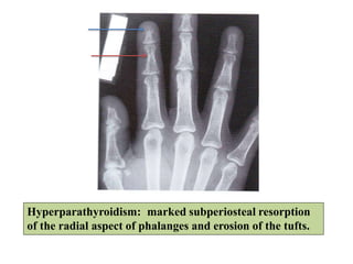 Hyperparathyroidism: marked subperiosteal resorption
of the radial aspect of phalanges and erosion of the tufts.
 