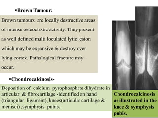 Brown Tumour:
Brown tumours are locally destructive areas
of intense osteoclastic activity. They present
as well defined multi loculated lytic lesion
which may be expansive & destroy over
lying cortex. Pathological fracture may
occur.
Chondrocalcinosis-
Deposition of calcium pyrophosphate dihydrate in
articular & fibrocartilage -identified on hand
(triangular ligament), knees(articular cartilage &
menisci) ,symphysis pubis.
Brown tumour in
tibia
Chondrocalcinosis
as illustrated in the
knee & symphysis
pubis.
 