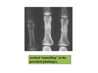 cortical ‘tunnelling’ in the
proximal phalanges.
 