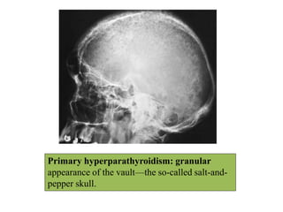 Primary hyperparathyroidism: granular
appearance of the vault—the so-called salt-and-
pepper skull.
 