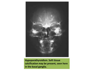 Hypoparathyroidism. Soft tissue
calcification may be present, seen here
in the basal ganglia.
 