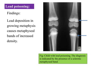 Lead poisoning:
Findings:
Lead deposition in
growing metaphysis
causes metaphyseal
bands of increased
density.
Fig: Child with lead poisoning. The diagnosis
is indicated by the presence of a sclerotic
metaphyseal band.
 