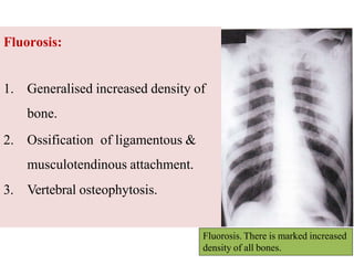 Fluorosis:
1. Generalised increased density of
bone.
2. Ossification of ligamentous &
musculotendinous attachment.
3. Vertebral osteophytosis.
Fluorosis. There is marked increased
density of all bones.
 