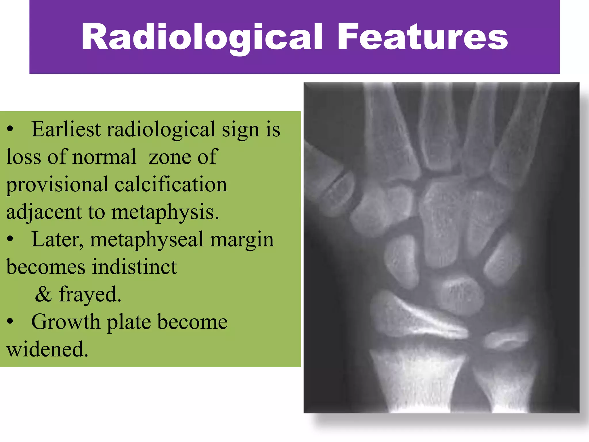 • Earliest radiological sign is
loss of normal zone of
provisional calcification
adjacent to metaphysis.
• Later, metaphyseal margin
becomes indistinct
& frayed.
• Growth plate become
widened.
Radiological Features
 