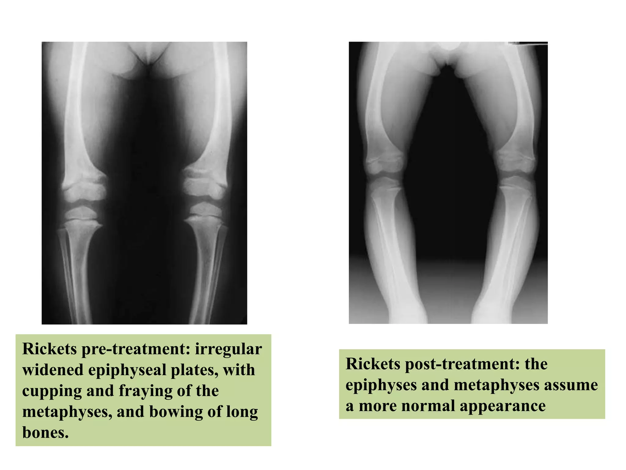 Rickets pre-treatment: irregular
widened epiphyseal plates, with
cupping and fraying of the
metaphyses, and bowing of long
bones.
Rickets post-treatment: the
epiphyses and metaphyses assume
a more normal appearance
 