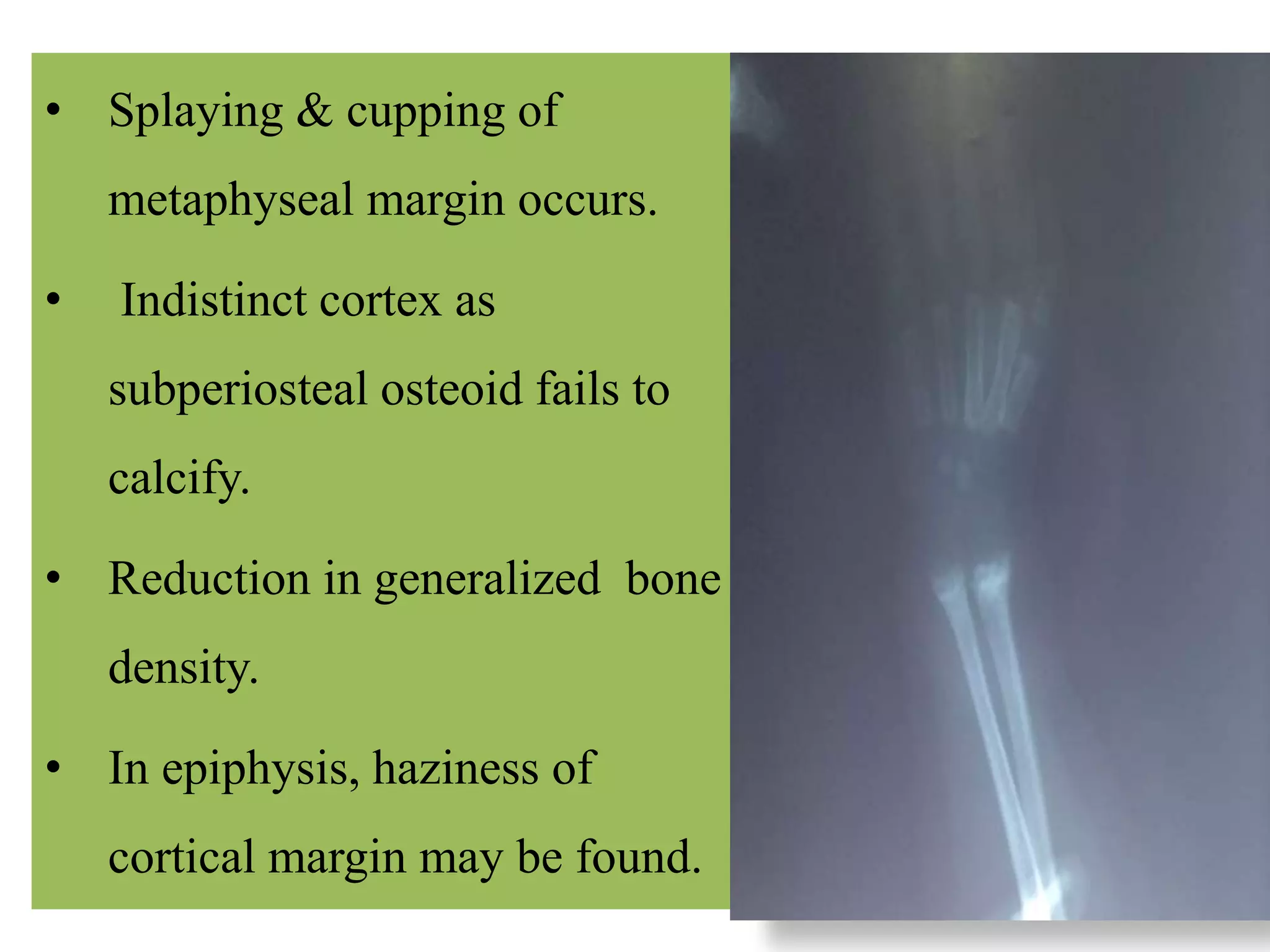 • Splaying & cupping of
metaphyseal margin occurs.
• Indistinct cortex as
subperiosteal osteoid fails to
calcify.
• Reduction in generalized bone
density.
• In epiphysis, haziness of
cortical margin may be found.
 