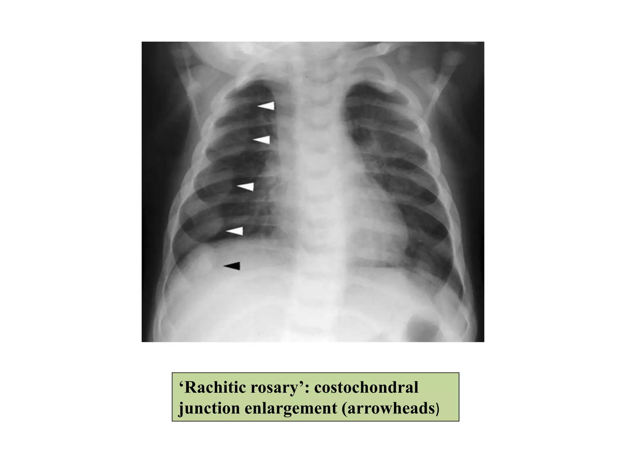 ‘Rachitic rosary’: costochondral
junction enlargement (arrowheads)
 