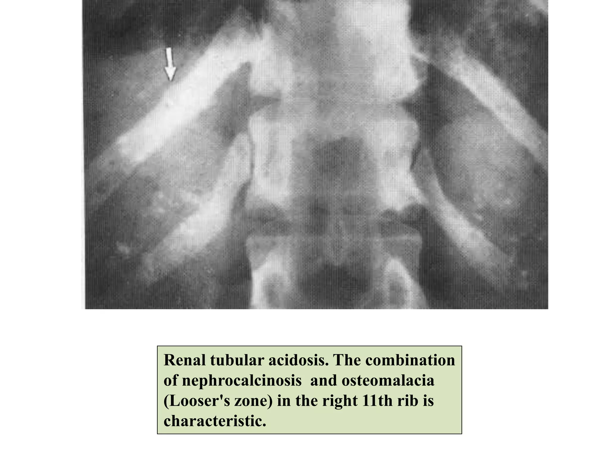 Renal tubular acidosis. The combination
of nephrocalcinosis and osteomalacia
(Looser's zone) in the right 11th rib is
characteristic.
 