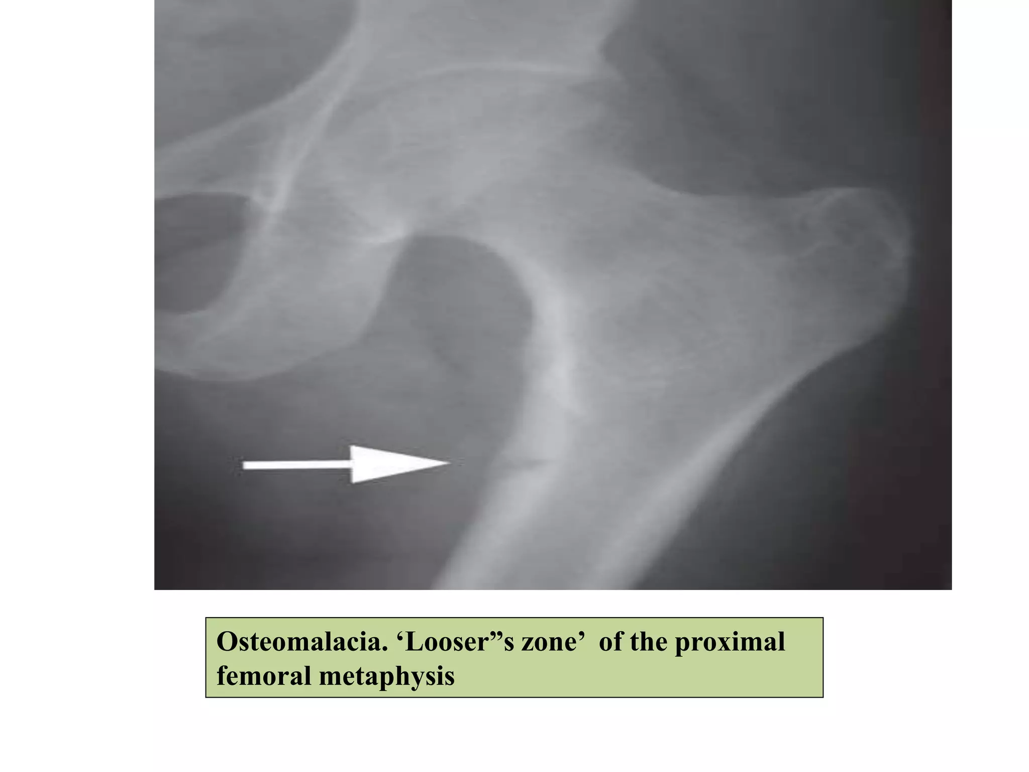 Osteomalacia. ‘Looser”s zone’ of the proximal
femoral metaphysis
 