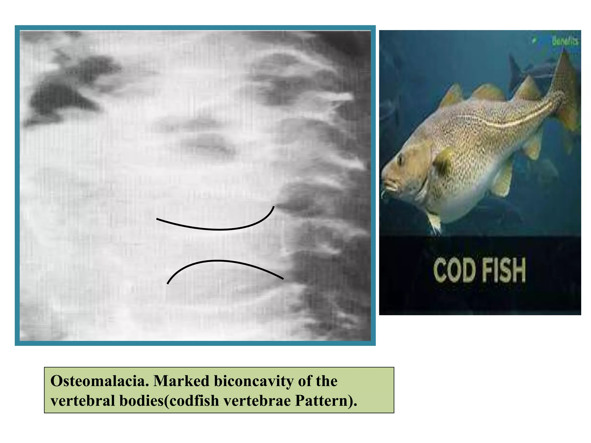 Osteomalacia. Marked biconcavity of the
vertebral bodies(codfish vertebrae Pattern).
 