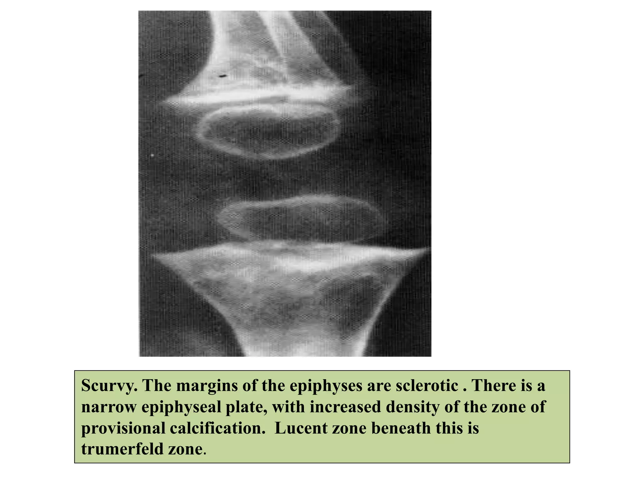 Scurvy. The margins of the epiphyses are sclerotic . There is a
narrow epiphyseal plate, with increased density of the zone of
provisional calcification. Lucent zone beneath this is
trumerfeld zone.
 