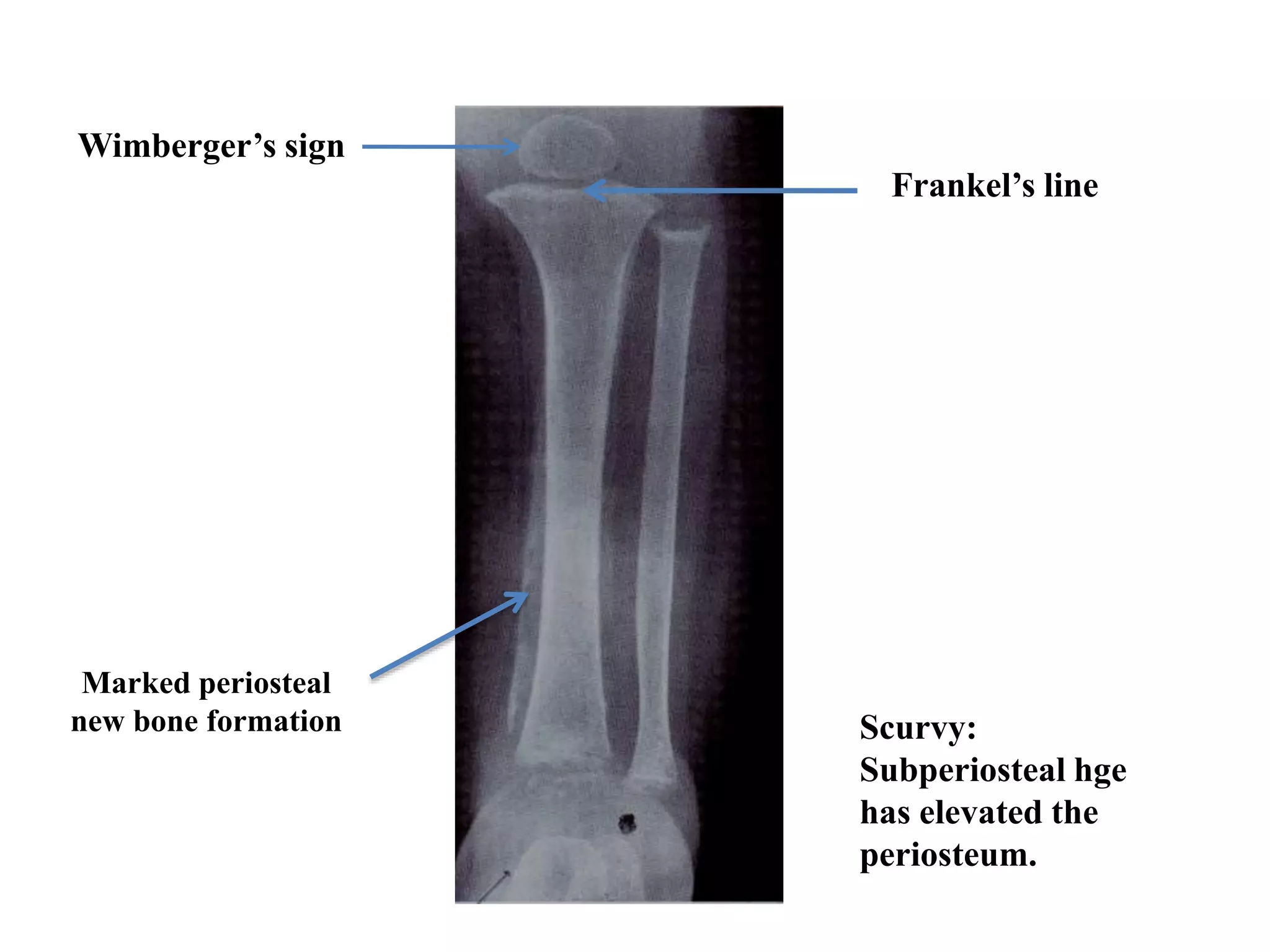 Scurvy:
Subperiosteal hge
has elevated the
periosteum.
Wimberger’s sign
Frankel’s line
Marked periosteal
new bone formation
 