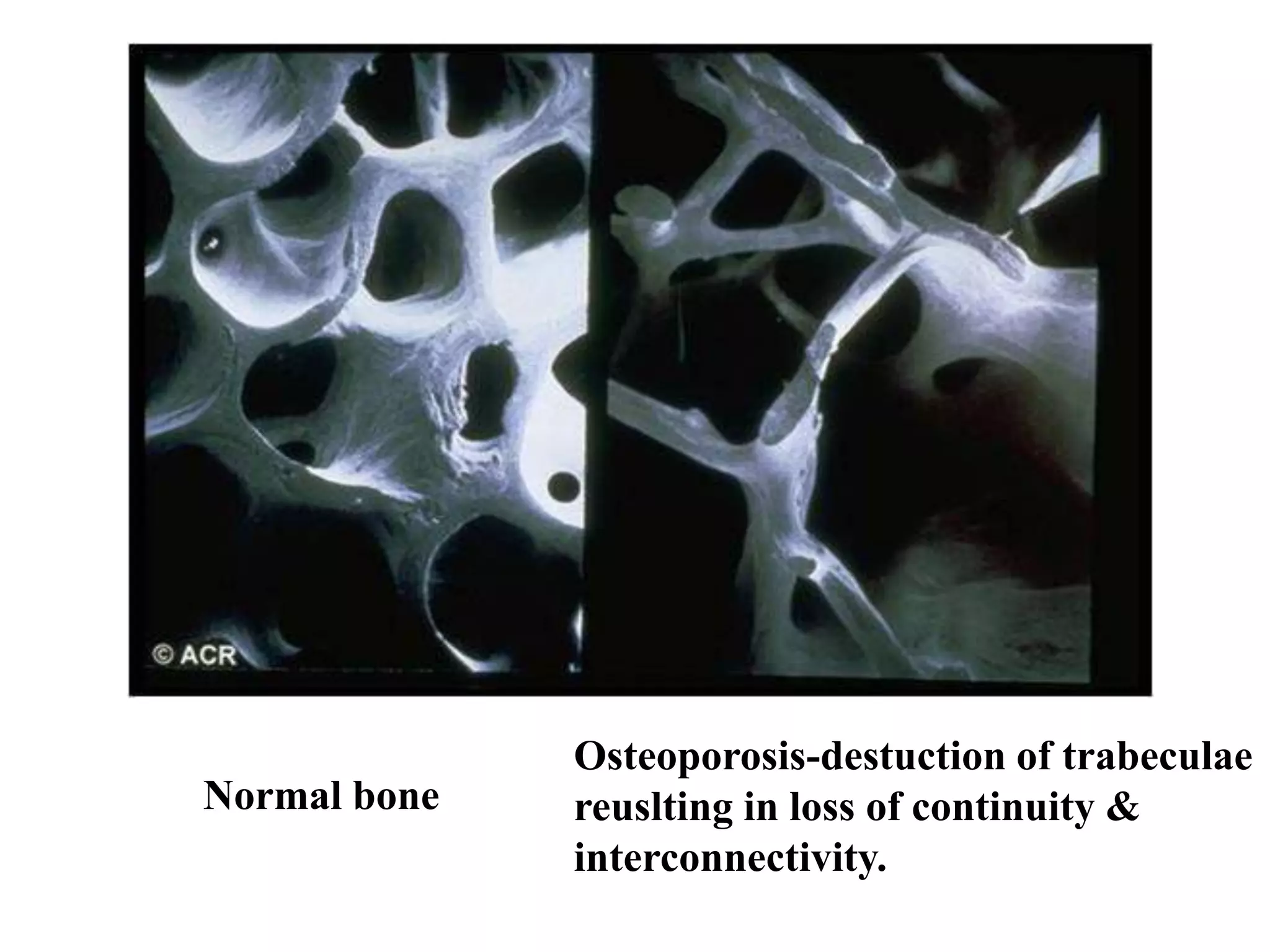 Normal bone
Osteoporosis-destuction of trabeculae
reuslting in loss of continuity &
interconnectivity.
 