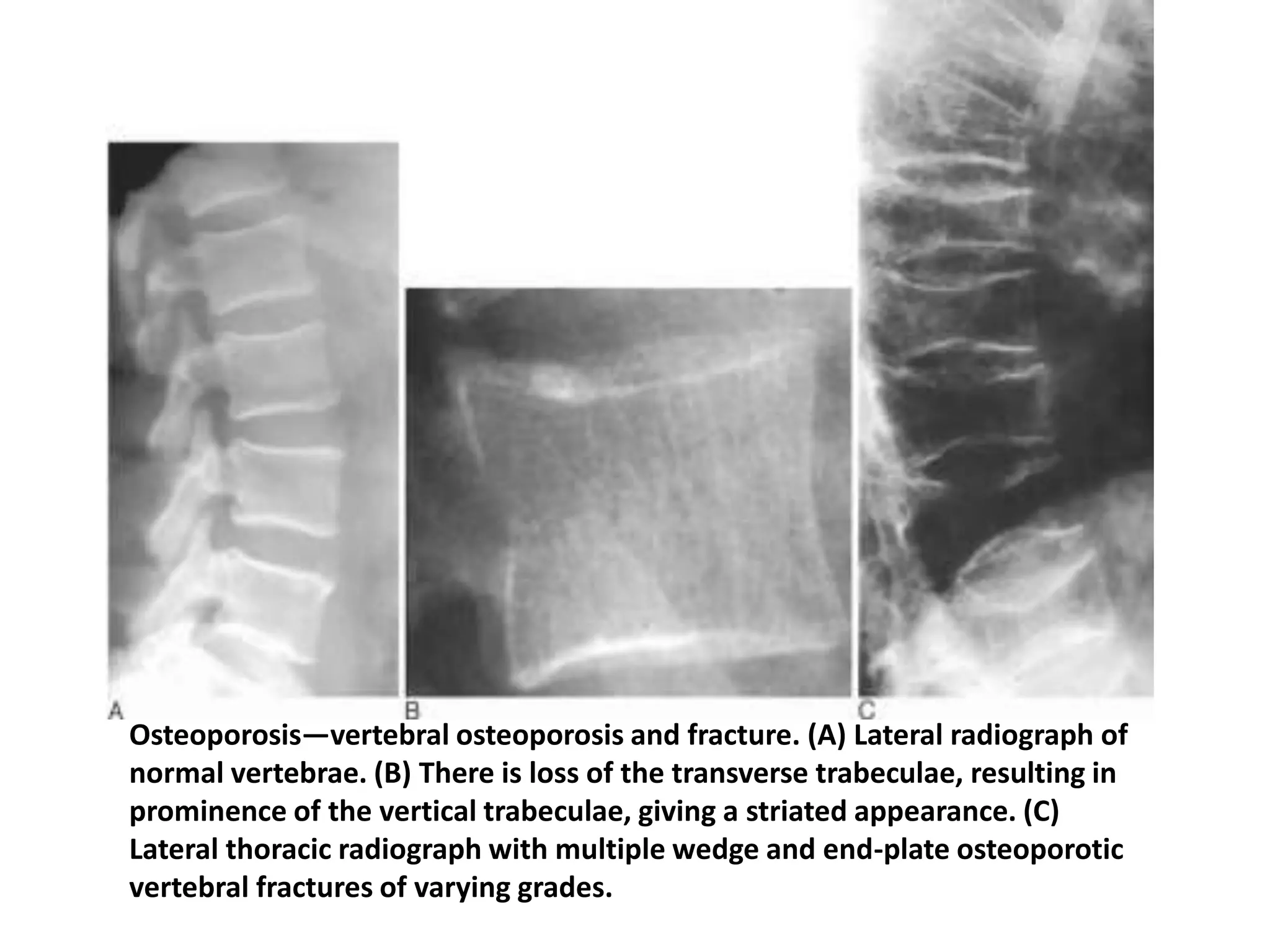 Osteoporosis—vertebral osteoporosis and fracture. (A) Lateral radiograph of
normal vertebrae. (B) There is loss of the transverse trabeculae, resulting in
prominence of the vertical trabeculae, giving a striated appearance. (C)
Lateral thoracic radiograph with multiple wedge and end-plate osteoporotic
vertebral fractures of varying grades.
 