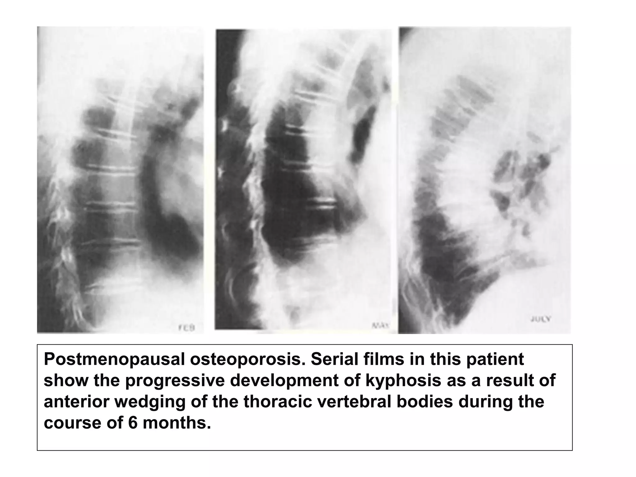 Postmenopausal osteoporosis. Serial films in this patient
show the progressive development of kyphosis as a result of
anterior wedging of the thoracic vertebral bodies during the
course of 6 months.
 
