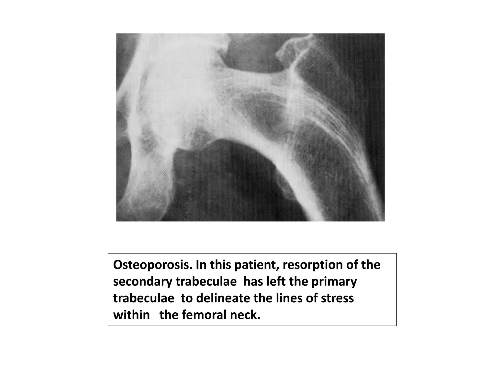 Osteoporosis. In this patient, resorption of the
secondary trabeculae has left the primary
trabeculae to delineate the lines of stress
within the femoral neck.
 