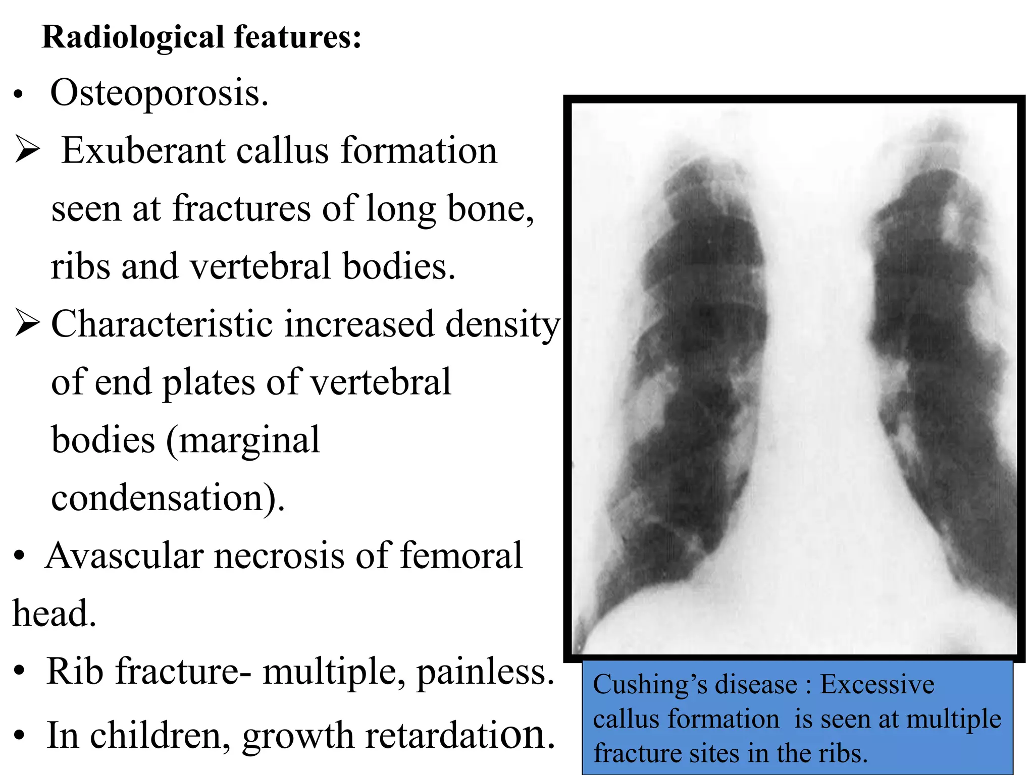 • Osteoporosis.
 Exuberant callus formation
seen at fractures of long bone,
ribs and vertebral bodies.
 Characteristic increased density
of end plates of vertebral
bodies (marginal
condensation).
• Avascular necrosis of femoral
head.
• Rib fracture- multiple, painless.
• In children, growth retardation.
Radiological features:
Cushing’s disease : Excessive
callus formation is seen at multiple
fracture sites in the ribs.
 