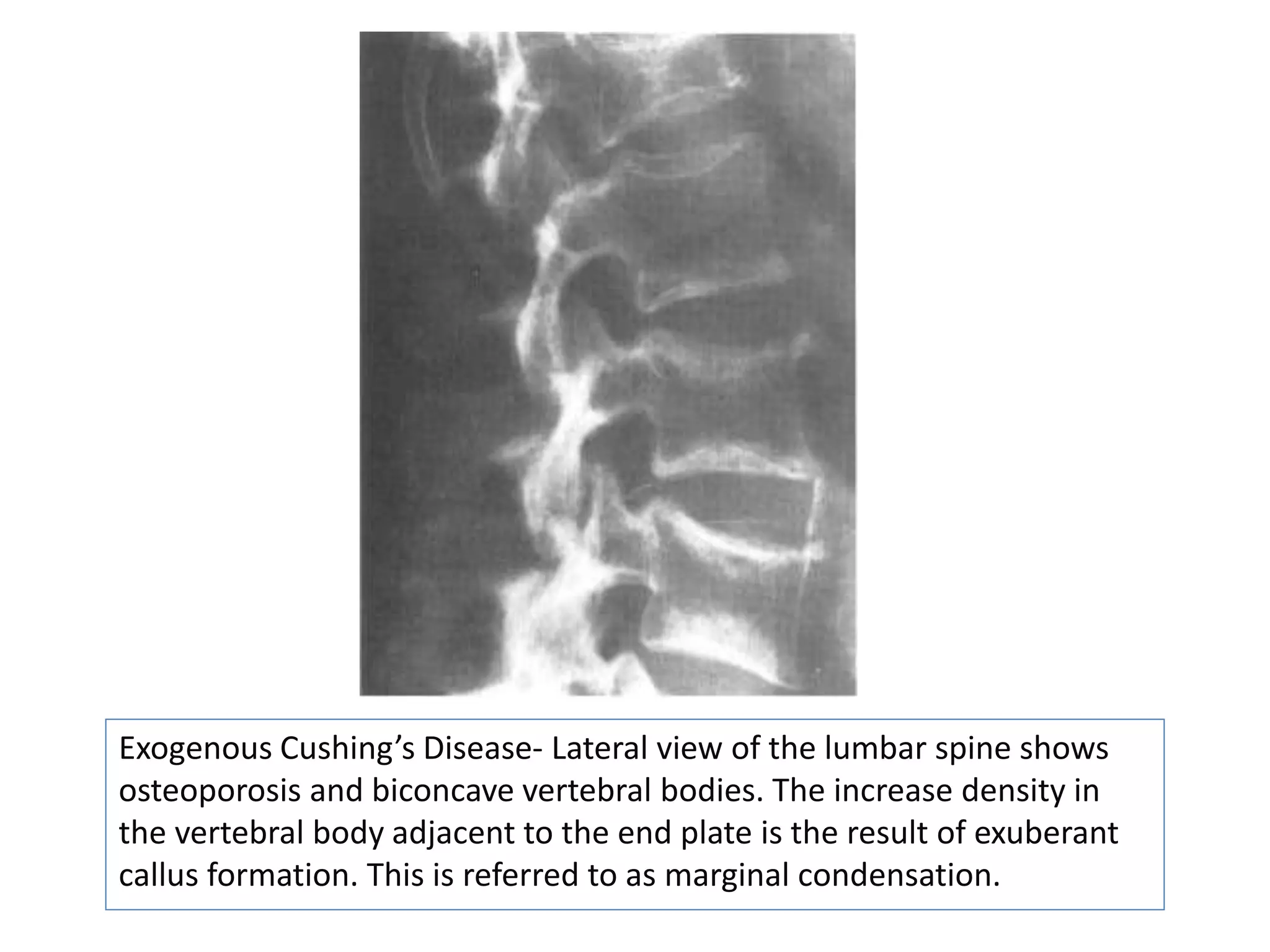 Exogenous Cushing’s Disease- Lateral view of the lumbar spine shows
osteoporosis and biconcave vertebral bodies. The increase density in
the vertebral body adjacent to the end plate is the result of exuberant
callus formation. This is referred to as marginal condensation.
 
