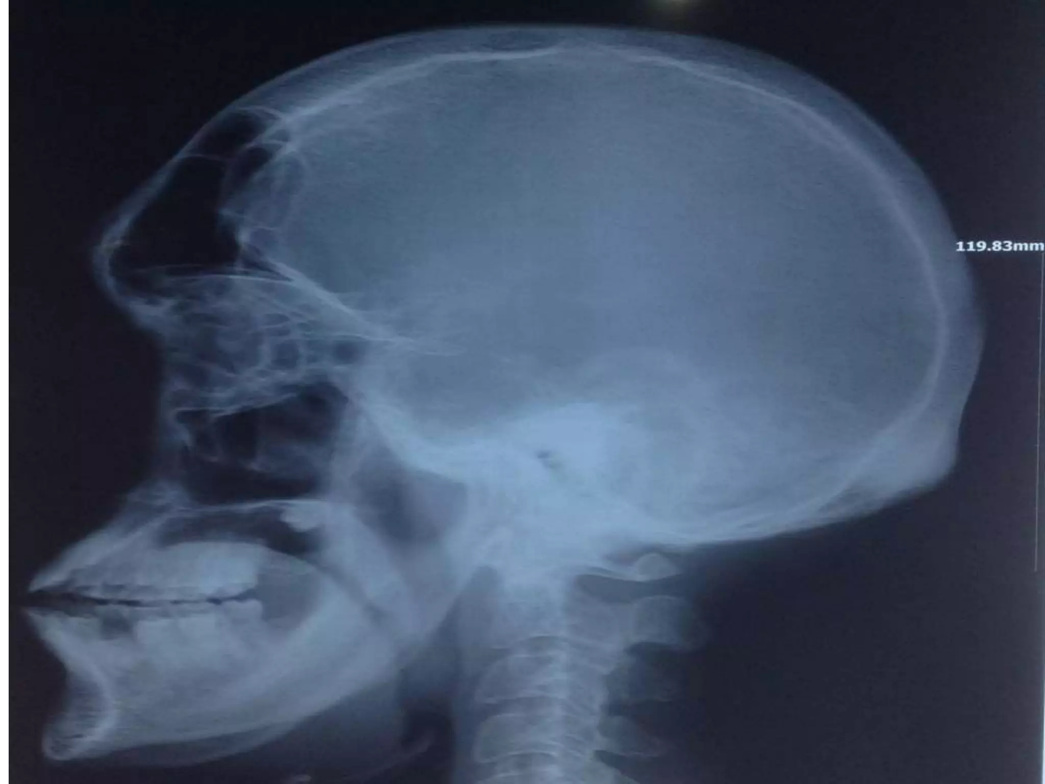 Acromegaly: frontal sinuses markedly enlarged & there is frontal
bossing.
 